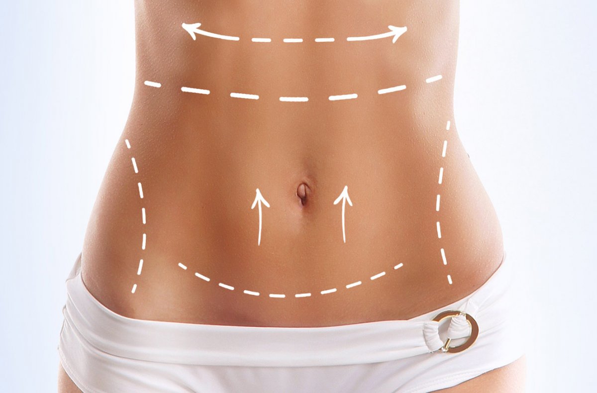 Karın Estetiği (Abdominoplasty): Miniabdominoplasty, Fullabdominoplasty