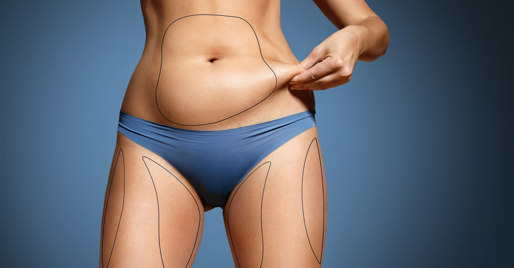 Vücut Şekillendirme, Yağ Çekme (Liposuction)